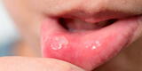 ¿Por qué salen úlceras en la boca?