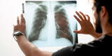 Ómicron: Conoce las secuelas de la nueva cepa del COVID-19 en los pulmones