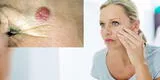 Cáncer de piel: sigue estos 3 consejos que te ayudarán a identificar los síntomas y prevenir riesgos