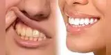 ¿Cuáles son los 5 mejores trucos caseros para blanquear los dientes?