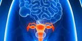 Qué es la endometriosis y cómo reconocer los síntomas