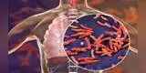 ¿Cómo se contagia la tuberculosis y qué hacer para reconocer los síntomas?