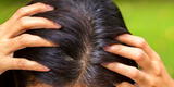 7 consejos para acabar con la caspa del cabello