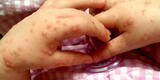 Pucallpa: Más de 50 niños presentarían el virus coxsackie, alertó la Diresa