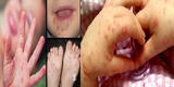 Virus coxsackie: ¿cómo reconocer los síntomas del “síndrome mano, boca y pie”