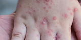 Virus Coxsackie: así puedes reconocer los síntomas y qué hacer para prevenirlo