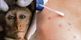 Viruela del mono llega a Latinoamérica: Argentina confirma primer caso de la enfermedad en paciente