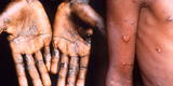 Viruela del mono: Minsa pide a la población estar “alerta” y recomienda "lavado de manos"