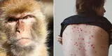 Viruela del mono: Minsa refuerza vigilancia de viajeros extranjeros