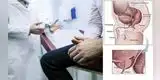 Aprende a reconocer el cáncer de próstata y cómo prevenirlo