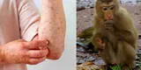 Viruela del Mono: ¿Cómo se contagia y cuáles son los síntomas de la enfermedad?