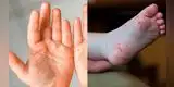 Minsa brinda recomendaciones para tratar el ‘síndrome de manos, pies y boca’ [VIDEO]