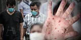 Viruela del mono: toda Lima Metropolitana está en riesgo de contagiarse, según el INS