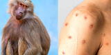 Viruela del Mono: ¿Cómo se contagia y desde cuándo aparecen los primeros síntomas de la enfermedad?
