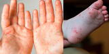 Áncash: reportan 58 casos del síndrome de manos, pies y boca en jurisdicción de Red Pacífico Sur