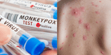 ¿Cuál es la diferencia entre la viruela y la varicela?