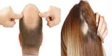 ¿Qué diferencia hay entre la calvicie y la alopecia?