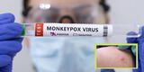 Viruela del mono: Esta es la principal fuente de infección, según expertos