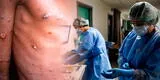 Viruela de mono en Perú: reportan segunda muerte por la enfermedad Monkeypox