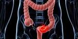 ¿Cómo reconocer las señales del cáncer de colon y qué causa la enfermedad?