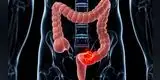 ¿Cómo reconocer las señales del cáncer de colon y qué causa la enfermedad?