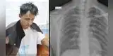 Huánuco: joven asiste a hospital por dolor de espalda y descubren que tenía un cuchillo incrustado