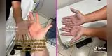 Joven va al médico por extraña coloración azulada en sus manos y recibe sorprendente diagnóstico