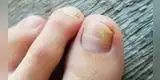 Conoce el mejor ingrediente casero para eliminar los hongos en las uñas de los pies
