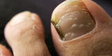 El remedio natural que elimina los hongos en las uñas de los pies para siempre