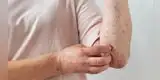 Vacunación contra el herpes zóster: clave para prevenir esta dolorosa enfermedad