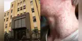 URGENTE | Minsa reporta 153 casos de sarampión en Perú: revisa las regiones donde el virus se expande