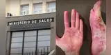 No solo afecta a niños | Minsa revela SÍNTOMA CLAVE del virus Coxsackie que los adultos no deben ignorar