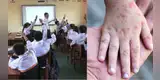 Colegios SUSPENDEN CLASES por brote de SARAMPIÓN en esta ciudad peruana: estudiantes vuelven a virtualidad