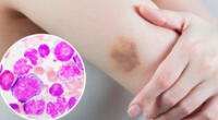 Leucemia mieloide aguda
