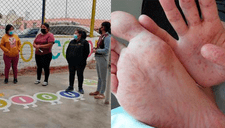 Ica: brote de síndrome mano-pie-boca genera pánico en colegio inicial de Chincha