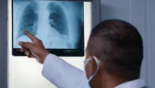 La tuberculosis peritoneal causa complicaciones que pueden llevar a la muerte