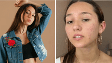 Alexia Barnechea rompe en llanto al mostrar su acné crónico: "Estoy pasando por mucho"