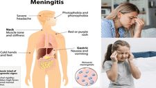 La meningitis puede causar la muerte en menos de 24 horas