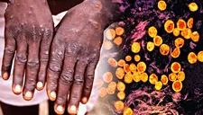 Virus mpox, la enfermedad con potencial pandémico que preocupa a nivel mundial