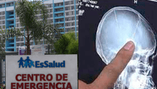 Niño con aguja en el cerebro fue operado con éxito: hospital lanzó contundente comunicado