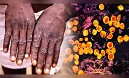 El Congo está sufriendo el mayor brote de mpox de su historia.