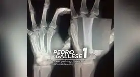 Esta es la radiografía que presentó Pedro Gallese para señalar la gravedad de su lesión.