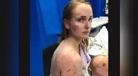 Así quedó cuerpo de mujer tras tormenta de granizo