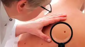 Si tu lunar cambia de tamaño, grosor y color deberías realizarte un despistaje.