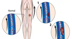 La trombosis venosa profunda es cuando un coágulo obstruye tus venas.