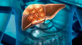 El cáncer de hígado se presenta en personas de 50 años a más.