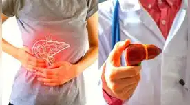 Si sospechas de los síntomas del cáncer de hígado lo mejor es acudir a tu médico para que descarte esta enfermedad.