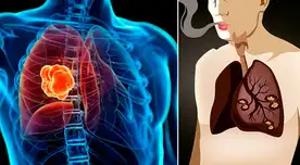 Síntomas iniciales y qué tratamiento se utiliza para el cáncer de pulmón. Síntomas iniciales y qué tratamiento se utiliza para el cáncer de pulmón.