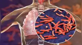 Conoce todo sobre la Tuberculosis.