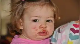 Conoce qué es el Virus Coxsackie